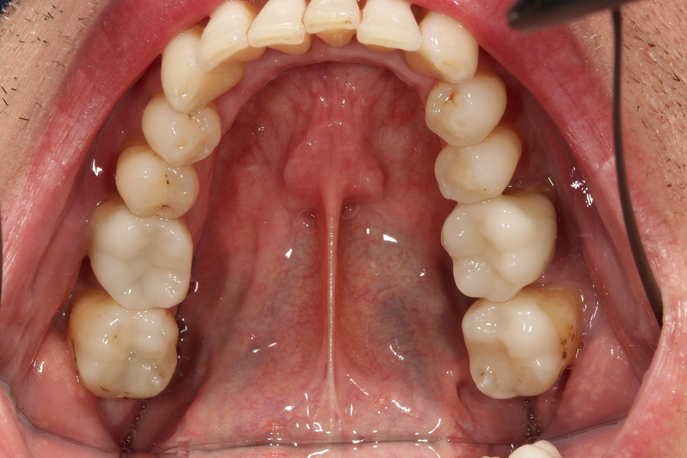 Fig. 13: Occlusal view after the treatment. Glass-ceramic crowns (n!ce), ...