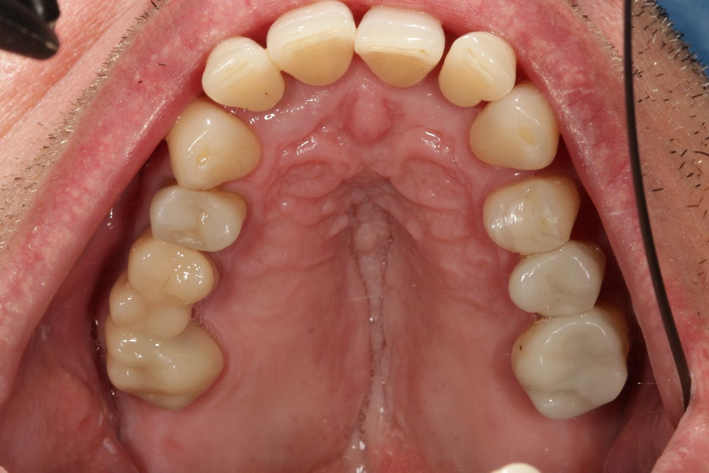 Fig. 14: ...composite fillings and a bridge of lithium disilicate in the maxilla