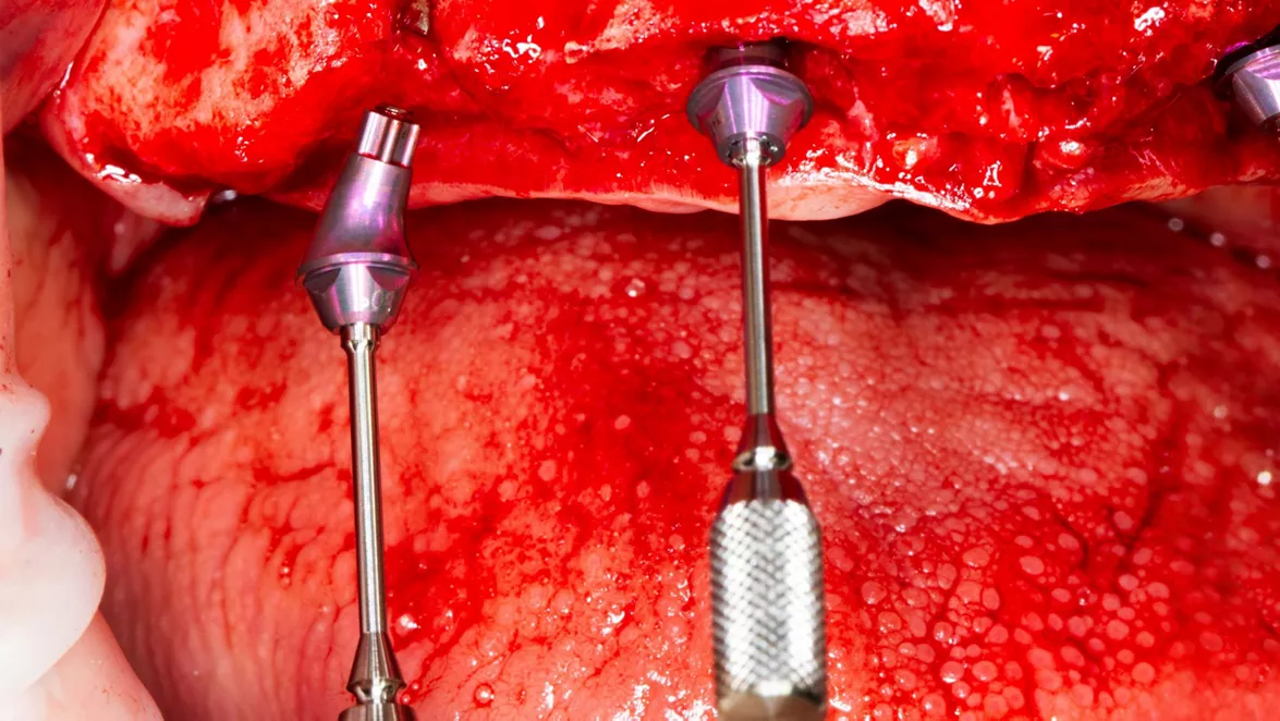 Placement of the Screw-retained Abutments (courtesy of M. Laureti and N. Ferrigno).