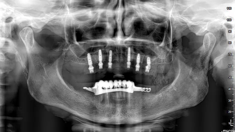 Immediate full-arch rehabilitation in the soft bone using Straumann® BLX 3,75 mm from 6 mm till 12 mm in one case (courtesy of B. Sobczak).