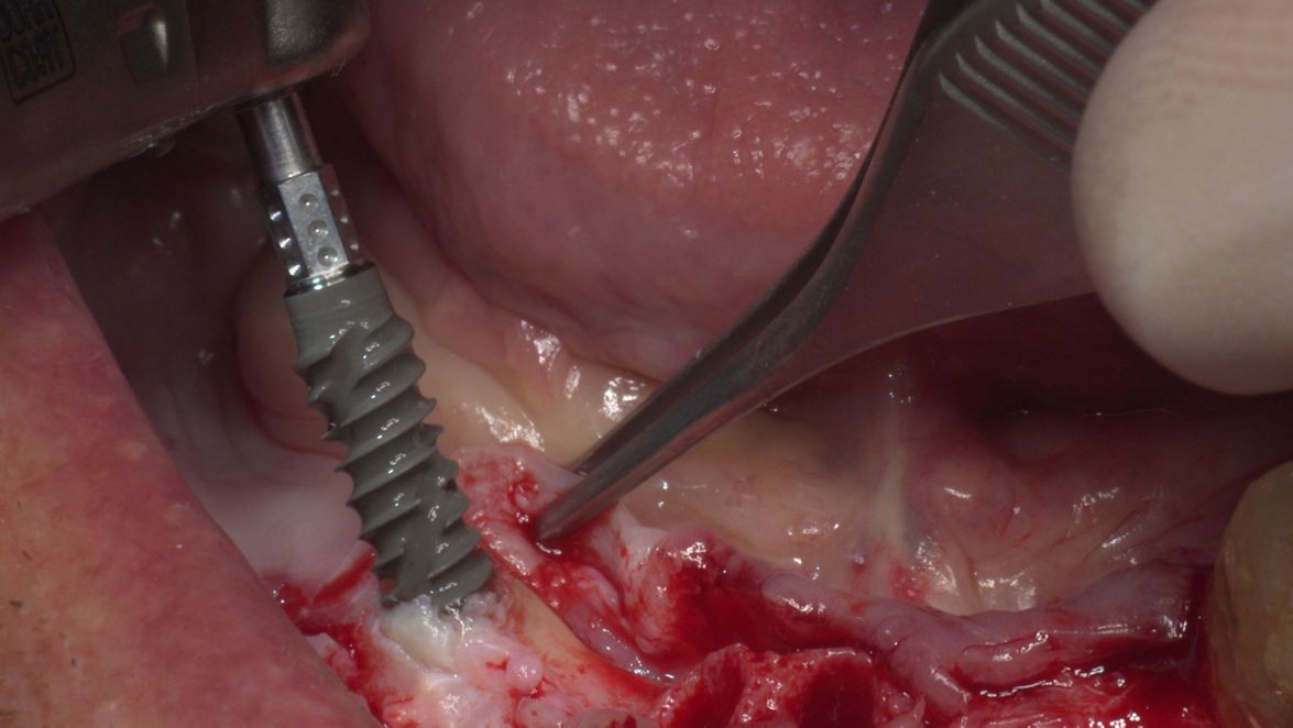 Immediate full-arch rehabilitation using Straumann® BLX 3.75 mm implant in the soft bone (courtesy of L. Cuadrado).