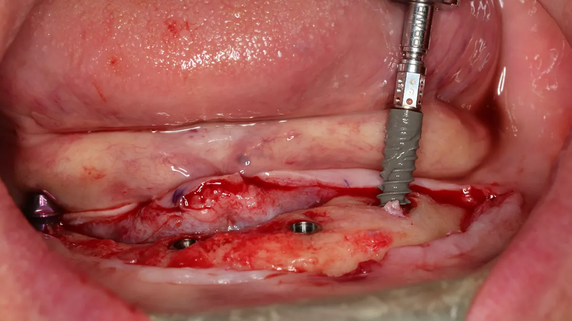 Immediate full-arch rehabilitation using Straumann® BLX 3.75 mm implant with 10 mm length in the hard bone (courtesy of Dr. L. Swart and P. van Zyl).