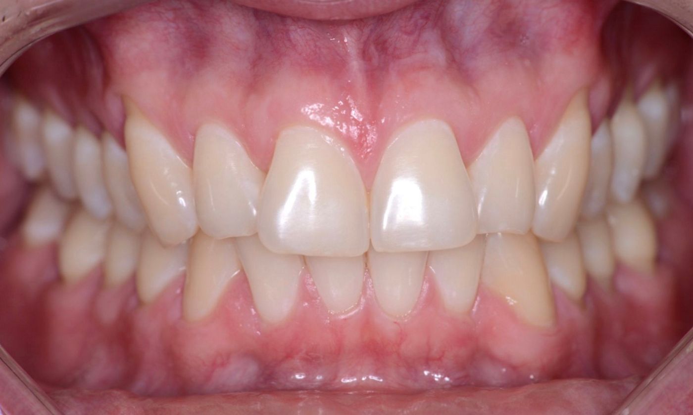 fig. 1 Initial aspect of generalized gingival recession in a young man