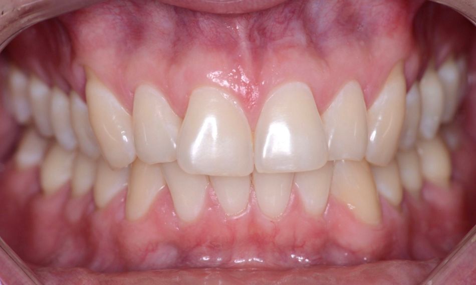 fig. 1 Initial aspect of generalized gingival recession in a young man