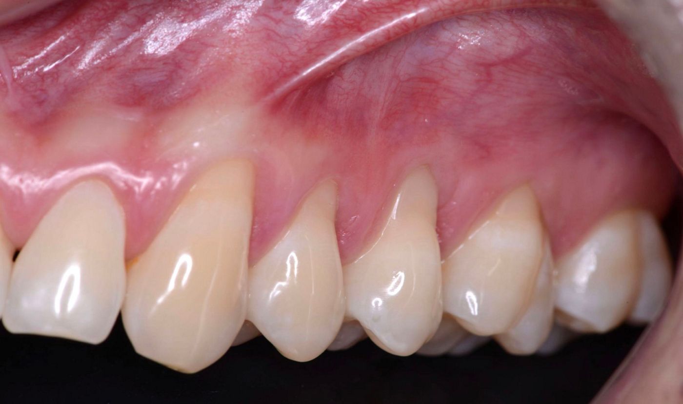 Fig 1B. Left side