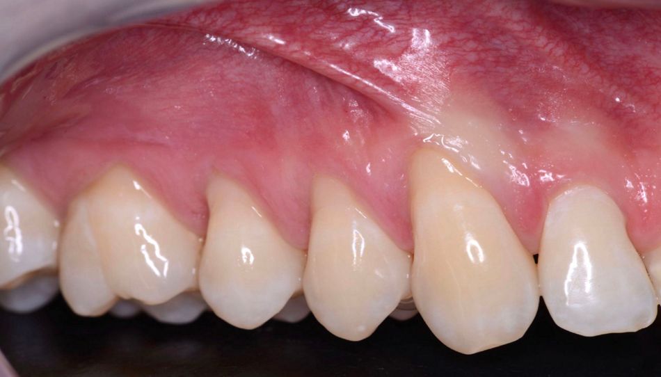 Fig 1C. Right side