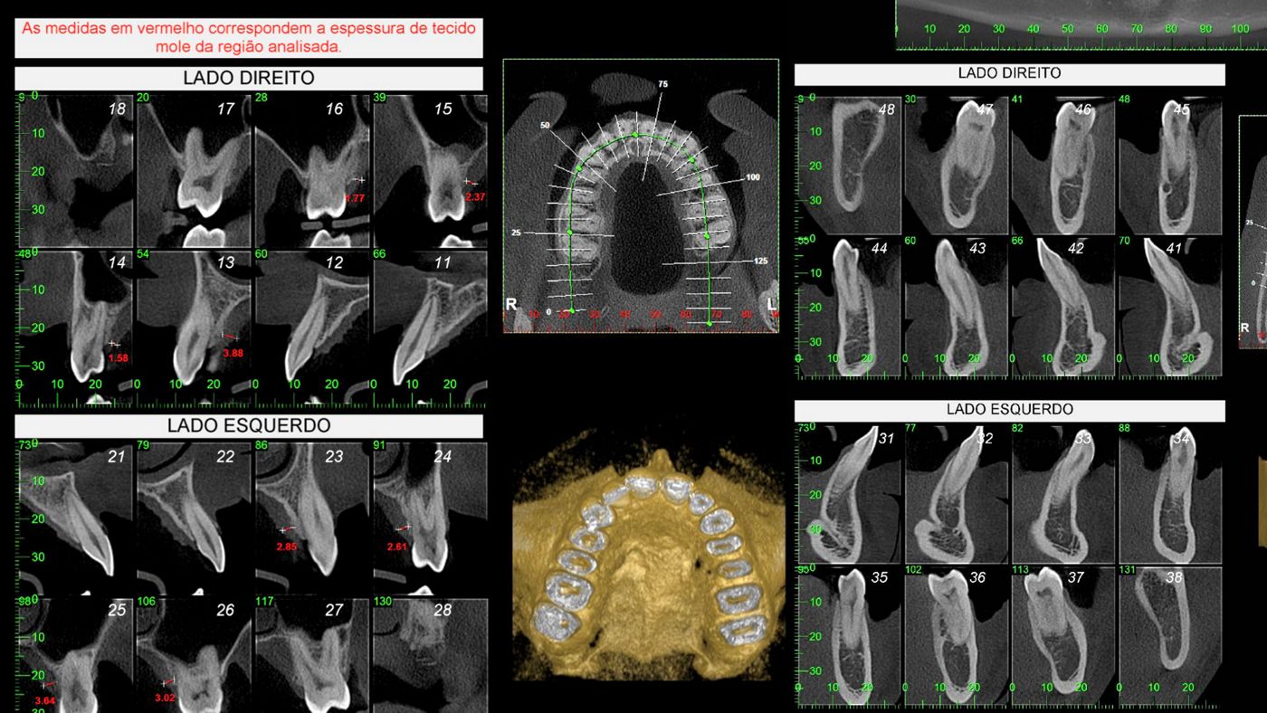 Fig 2. Preoperative CBCT