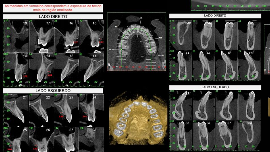 Fig 2. Preoperative CBCT