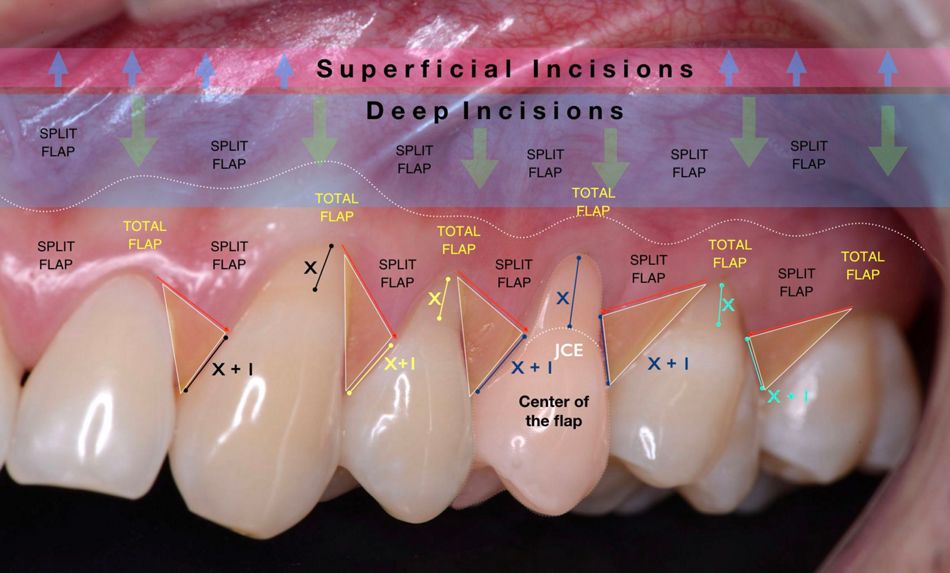 Fig 3. Left side, after preparation of the envelope flap, the connective tissue graft was positioned to cover the recessions