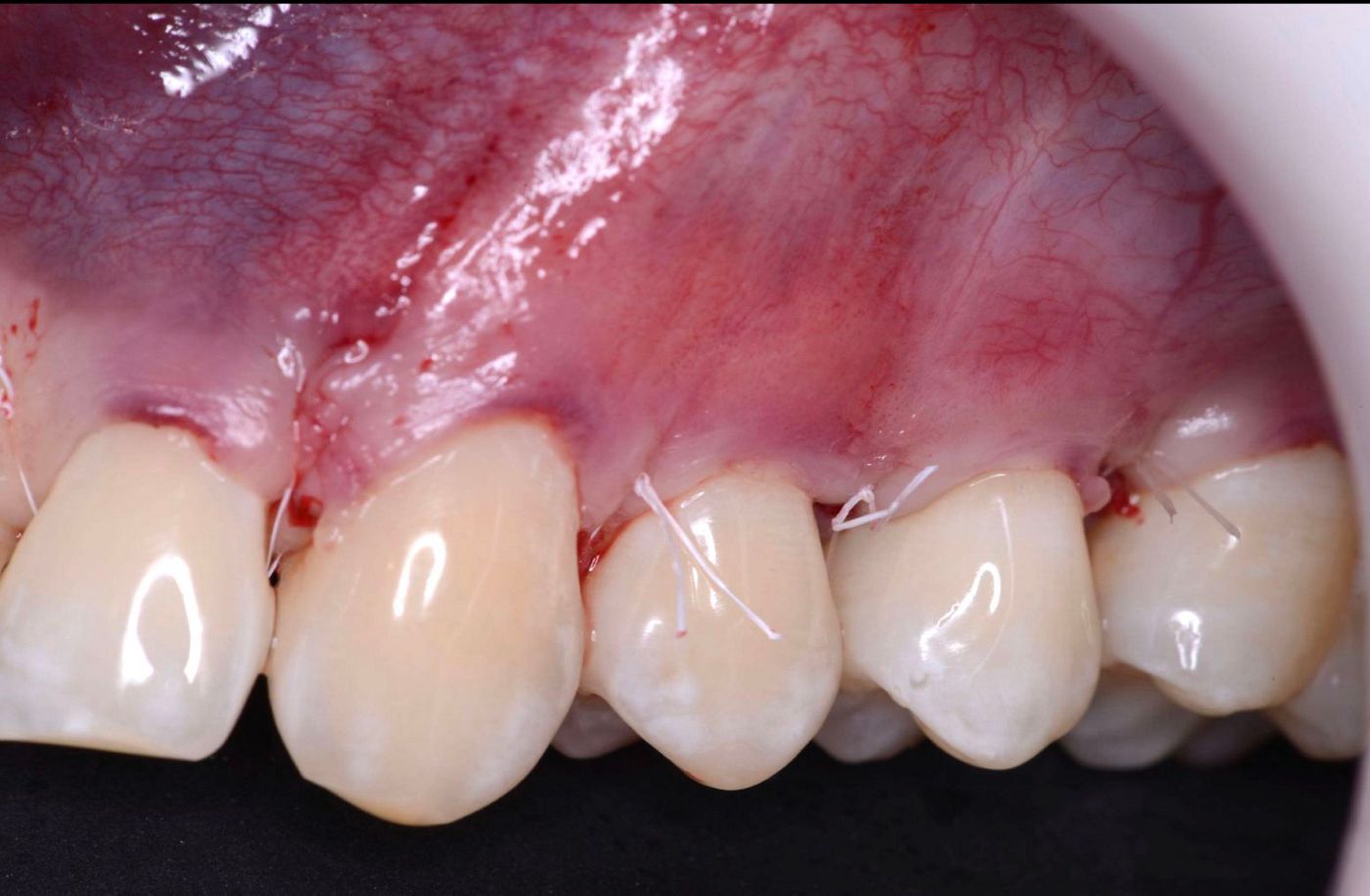 Fig 4. Immediate post-operative