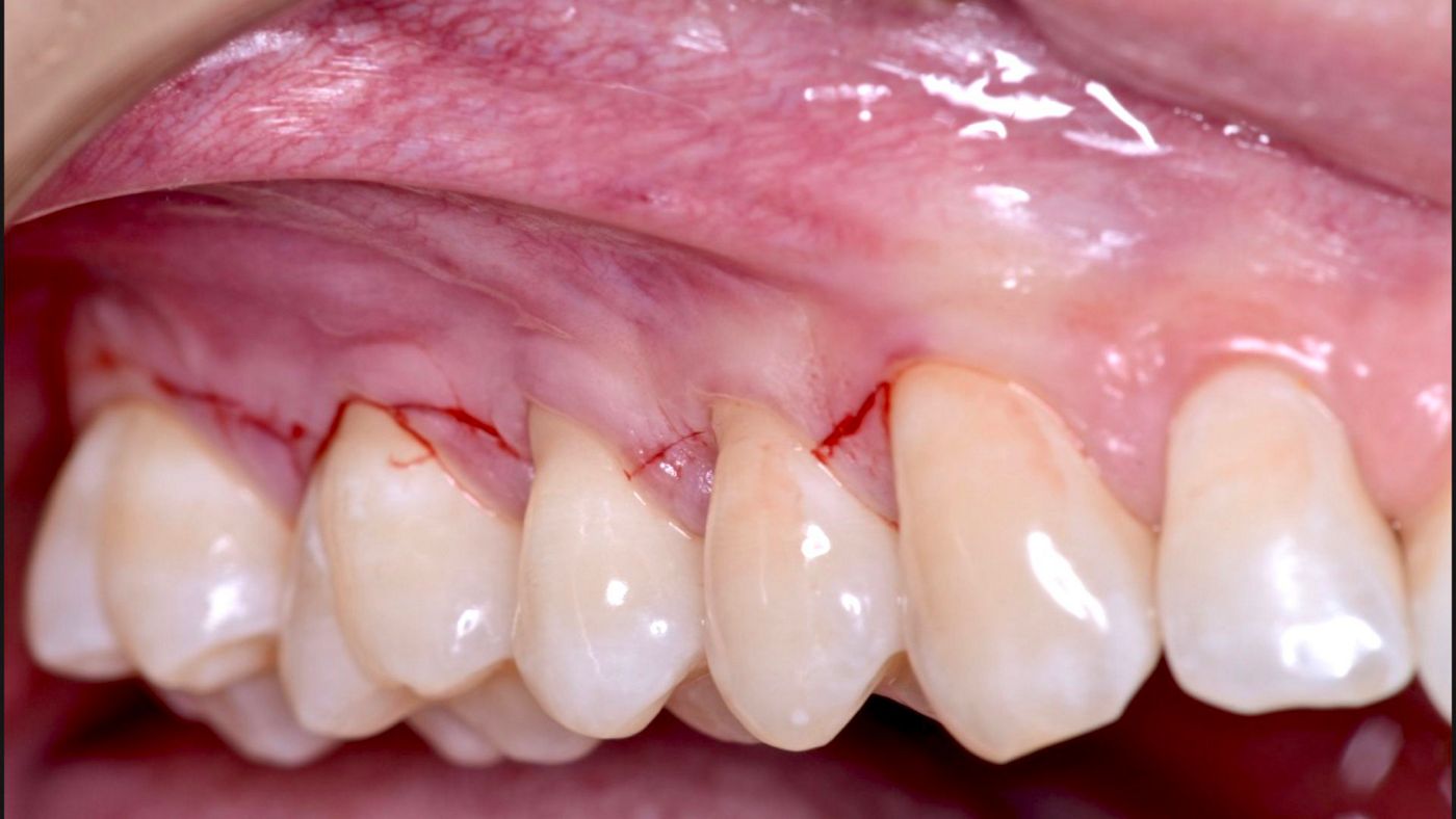 Fig 5. Flap design and mucoderm® before hydration