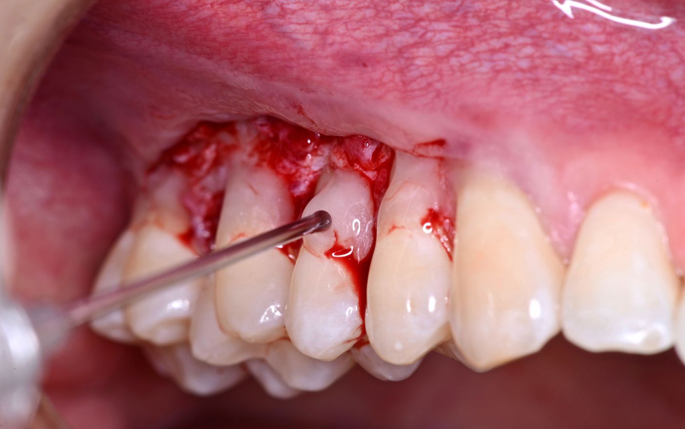 Fig 7. Application of Straumann Emdogain(R) to the root surfaces