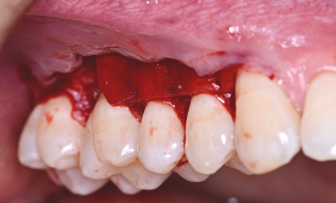 Fig 8. mucoderm® positioned to cover the roots, immediately after surgery