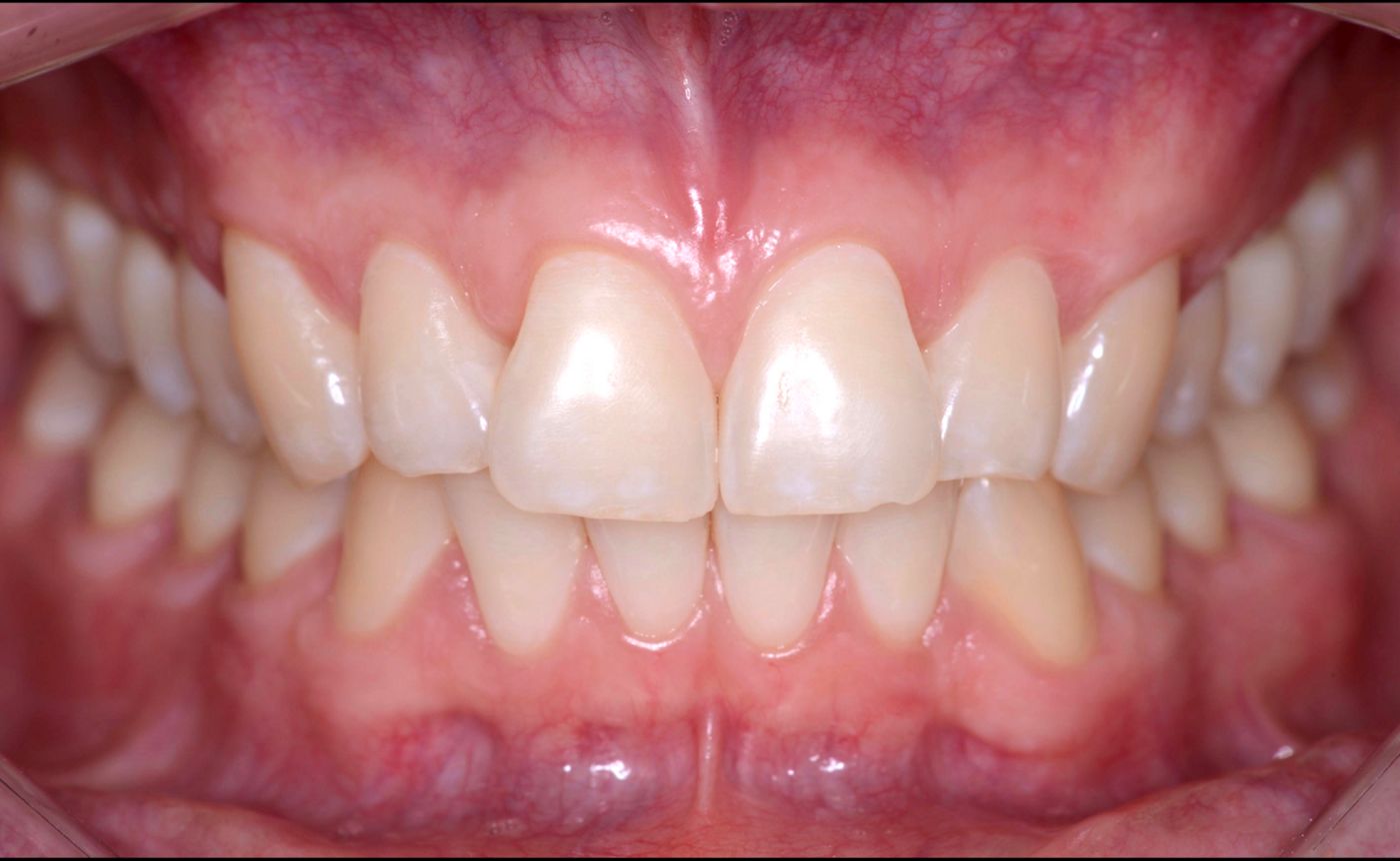 Fig 9. One year follow up, similar results on both sides
