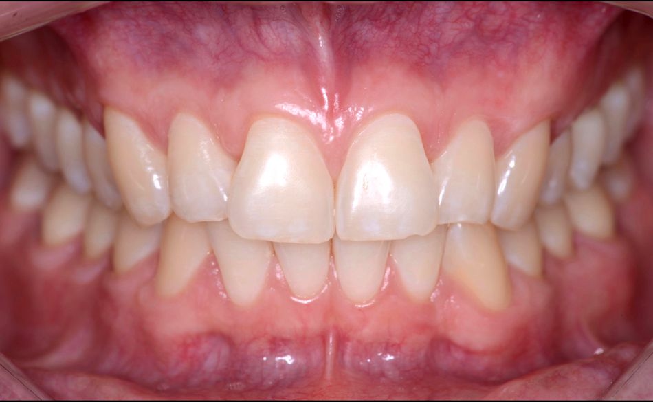 Fig 9. One year follow up, similar results on both sides