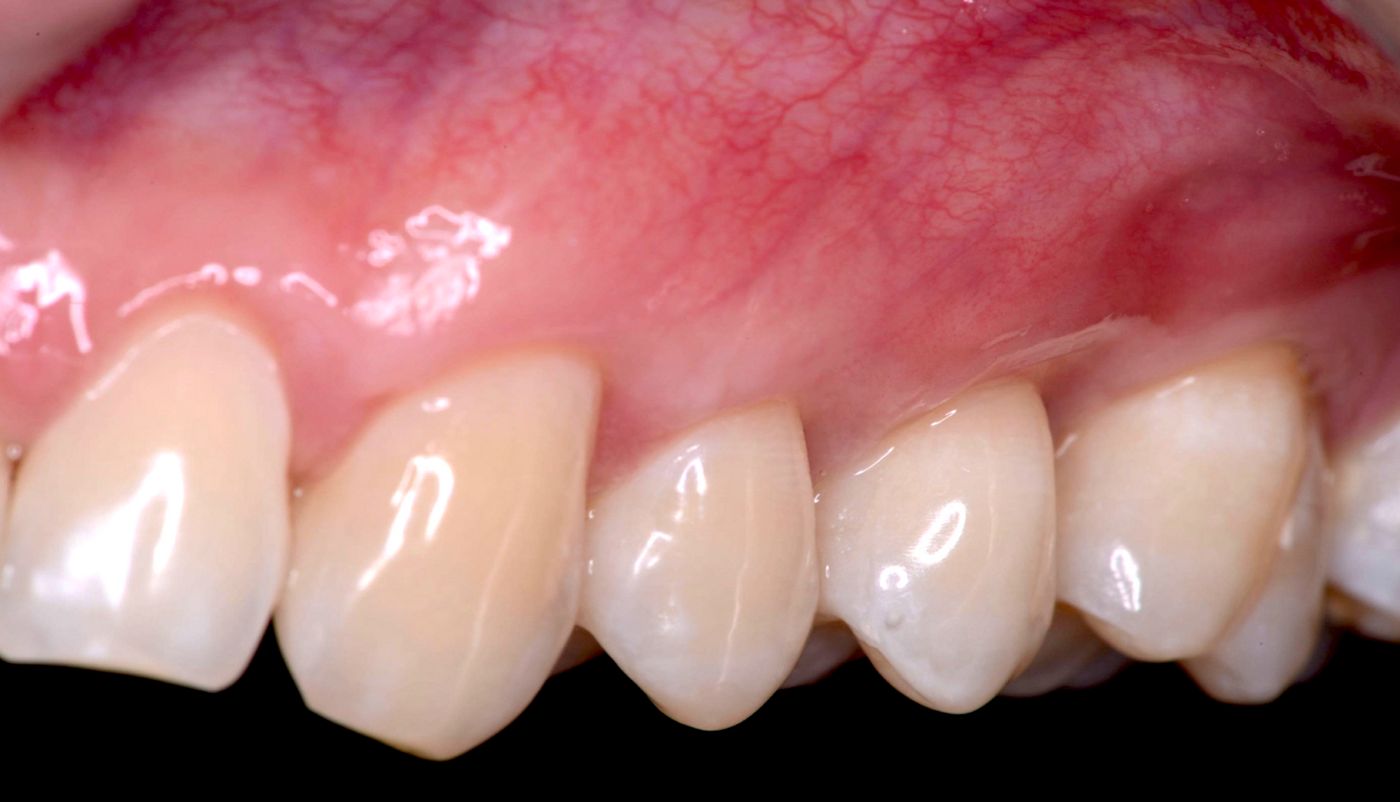 Fig 9B. Left side 