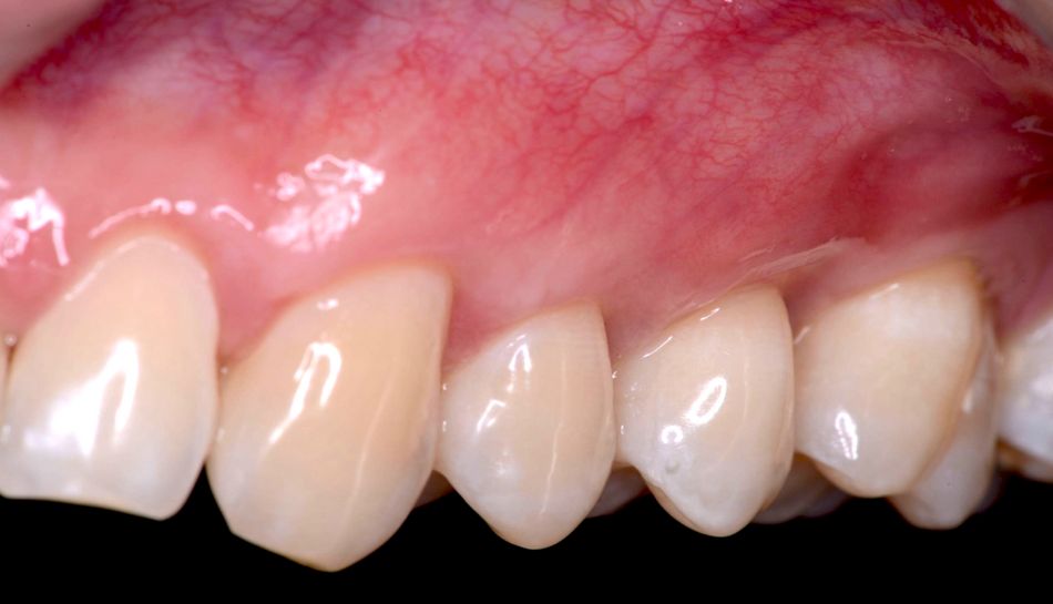 Fig 9B. Right side
