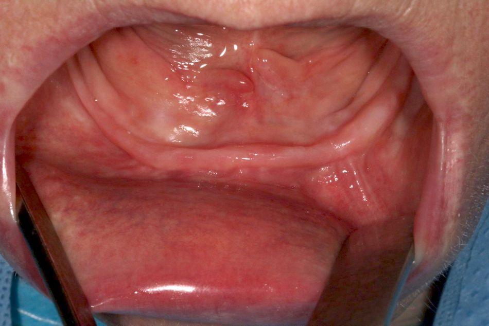 fig. 1 thin mandibular bone ridge 
