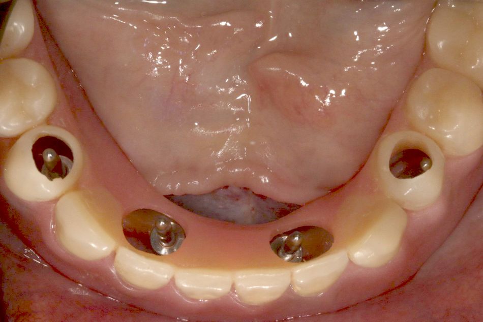 fig. 5 checking implant bed with prosthesis