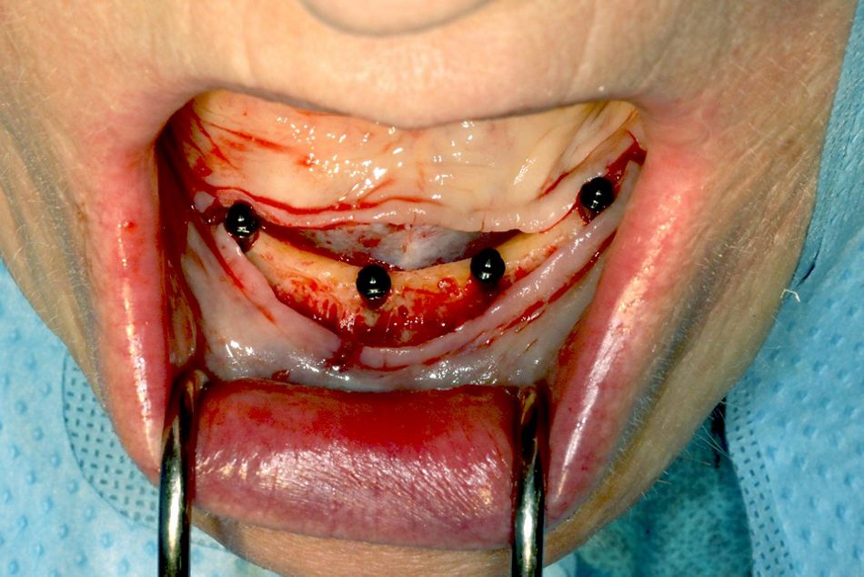 fig. 6 mini Implants inserted
