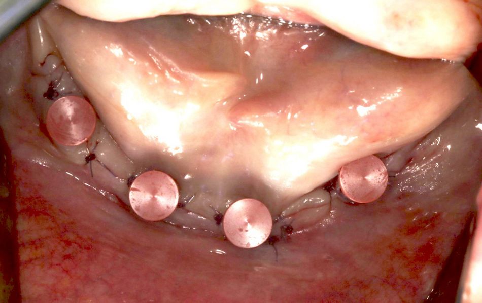 fig. 7 forming/fixing matrices placed on implants for impression taking