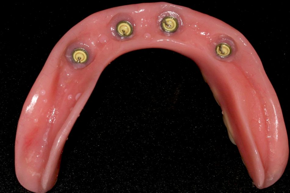 fig. 9 finalized prosthesis