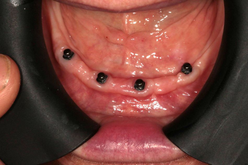 fig. 10 after three months of healing time