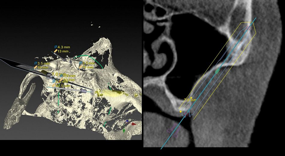Fig. 1	UR 15 Virtual (extra-sinus planning) Radiographic cut on 2 and 3D visions representing a simulation for an extra-sinus path of the right implant. According to the ZAGA Concept, when facing anatomical situations showing less than 4-5 mm of bone at the sinus floor level, a more reliable bone sealing at coronal level is achieved by buccal shifting of the osteotomy. As illustrated, the coronal BIC surface increases from 1,7 to 7 mm. Antrostomy position is apically displaced and sinus lining integrity is respected. 