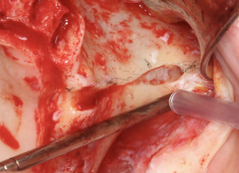 Fig.12.	Left osteotomy Detail of the left ZAGA channel osteotomy prepared accordingly to the virtual planning. Minimal destruction of the alveolar bone and maxillary wall has been performed. Note the enlarged but protective maxillary bone able to integrate with the implant. Note also the achieved sinus lining integrity.  The antrostomy site was moved to an apical position on the zygomatic process of the maxillary bone.