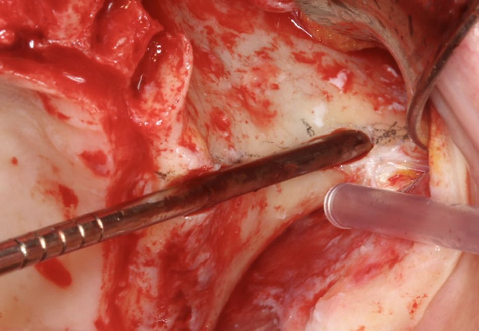 Fig.13.	Measuring left osteotomy Implant length is estimated with a 2,9mm diameter gauge