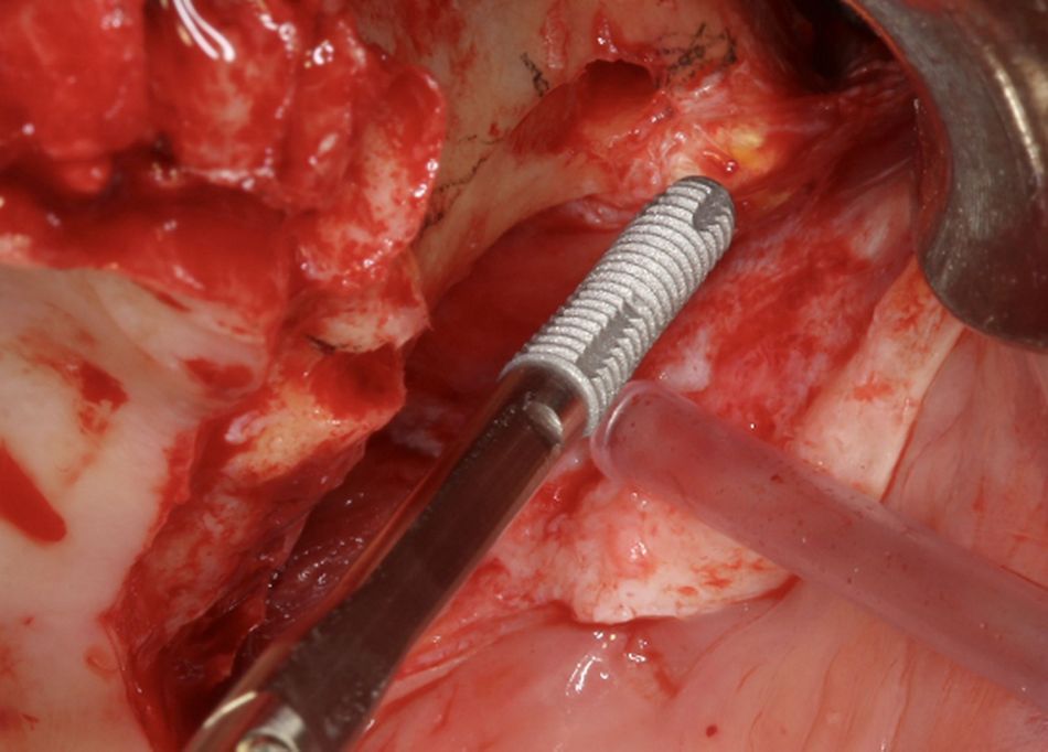Fig.14.	Left flat implant.1  A flat tapered implant design (Straumann Zygomatic Implant ZAGA®-Flat) is presented and its body compared to the osteotomy size. Note that the tapered apical part of the implant is provided with cutting flutes.  The self-tapping flutes are helping the flat implant design (Straumann ZAGA®-Flat) to smoothly penetrate the external cortical of the zygomatic process with enhanced primary stability.
