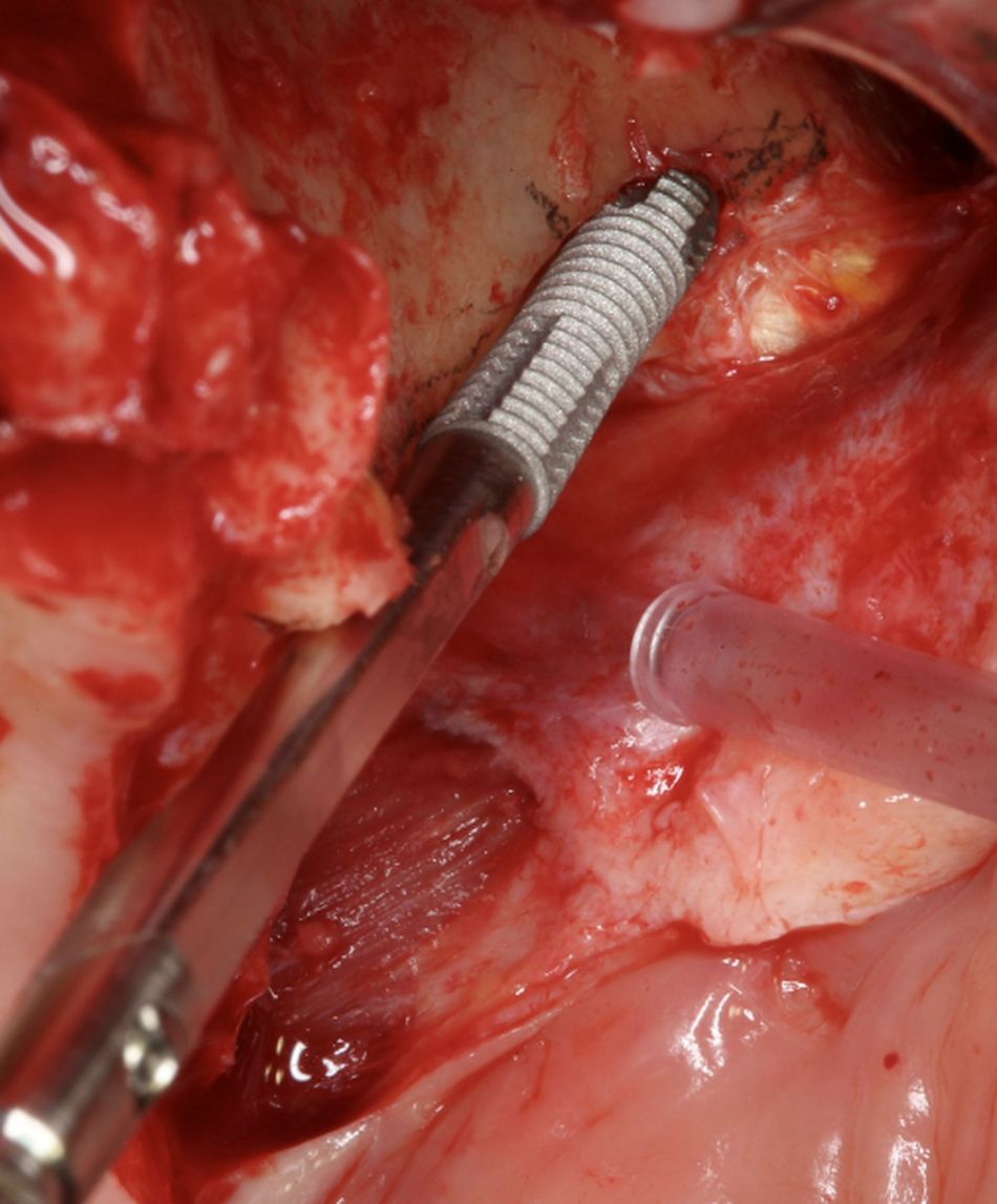Fig.15.	Left flat implant.2 The clinical picture is pointing out (Straumann Zygomatic Implant ZAGA®-Flat) implant tip features (see implant picture). The benefit in adapting implant and implant-bed dimension and shape corresponds to a final drill -implant diameter difference of 1 mm. That unique tapered design feature on a zygomatic implant together with the use of a ZAGA conservative osteotomy, allows for an increased implant primary stability. 
