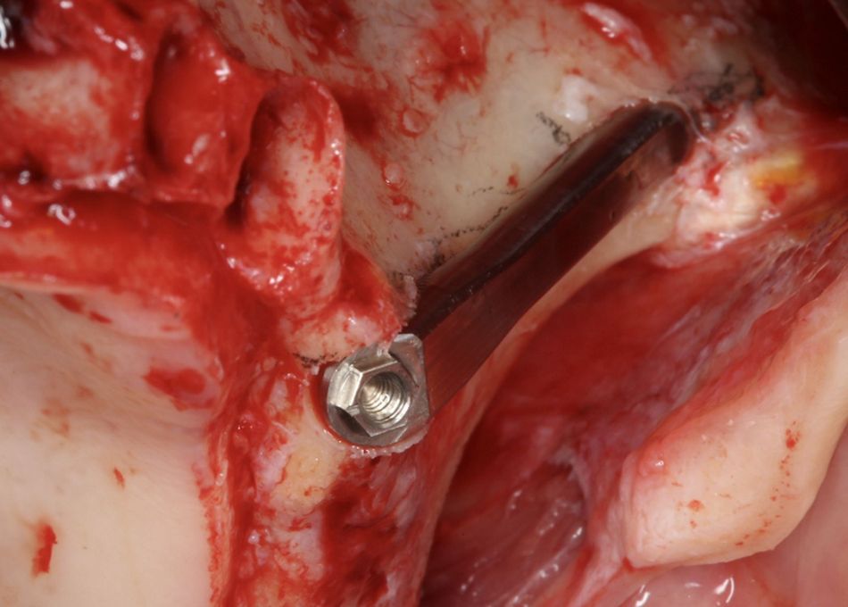 Fig.17.	Left flat implant.4 The implant in place is partially outside the bone envelope. To diminish eventual vascular compression of the soft tissues, the implant (Straumann Zygomatic Implant ZAGA®-Flat) has a flat section. To reduce eventual bacterial contamination, the implant body is made of non-threaded turned grade 4 titanium. 
