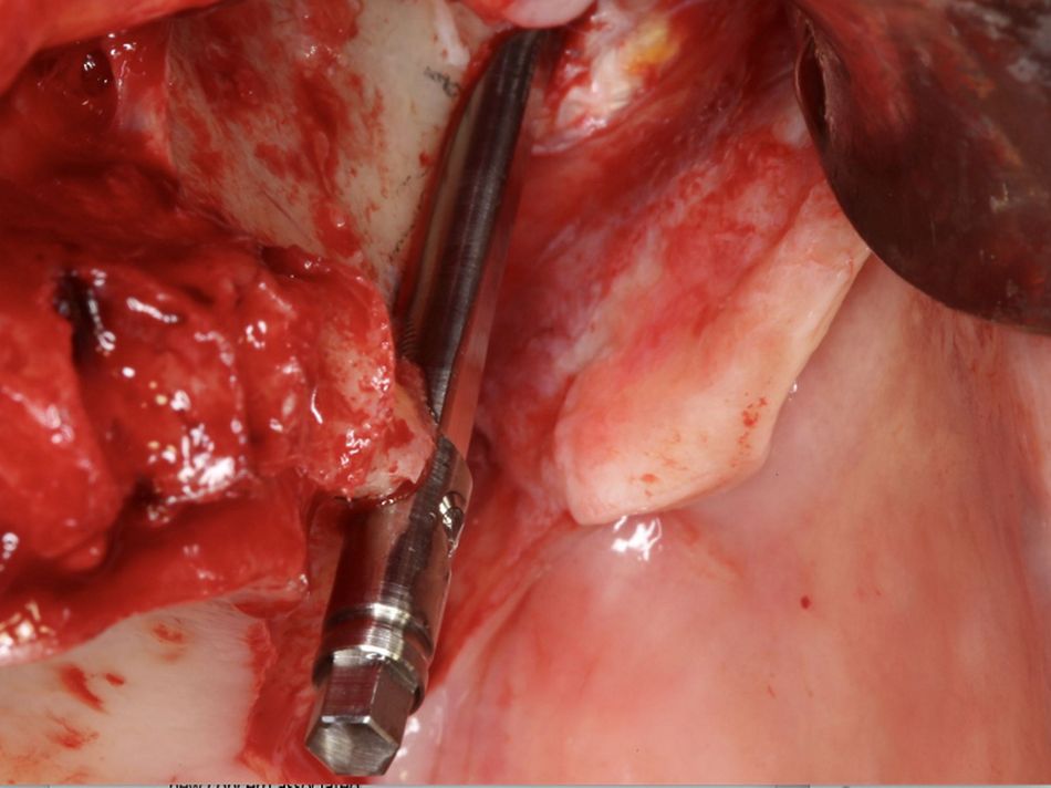 Fig.18.	Left flat implant lateral.1 Clinical lateral view of the flat implant (Straumann ZAGA®-Flat) design. Note the difference with the classic round designs in both the amount and the type of surface facing the soft tissue.