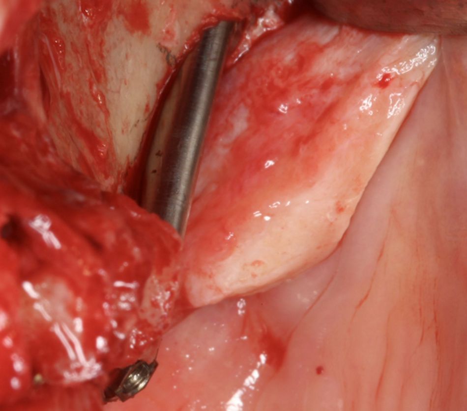 Fig.19.	Left flat implant lateral.2 Straumann Zygomatic Implant ZAGA®-Flat implant in place from a lateral view. Note that its flat profile is not protruding out the remaining alveolar bone.