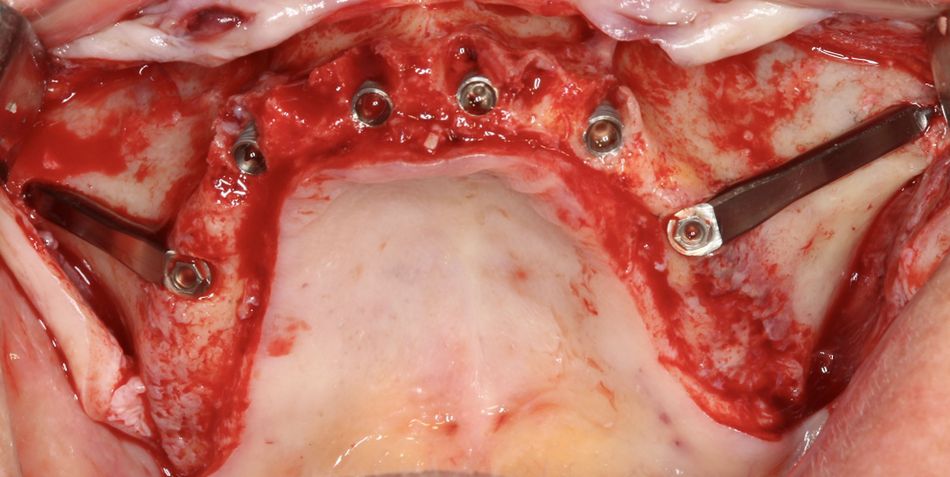 Fig.20.	Occlusal post-surgery Occlusal post-operative view. Two flat design, apically threaded and body turned titanium surface, have been placed. Implant head are in a prosthetically driven position sealing the ZAGA “canal type” osteotomy.