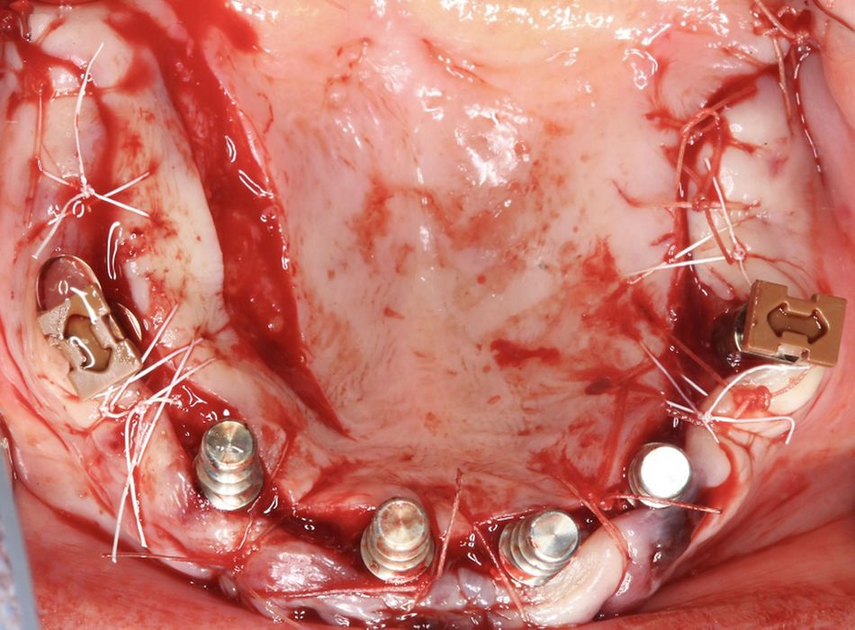 Fig.21.	Occlusal sutured To maximize the amount of keratinized tissue buccal to the implant, a palatal incision was made. To make possible a first intention closure of the soft tissue, double pediculated partial flap was performed. Non resorbable mattress suture was used.
