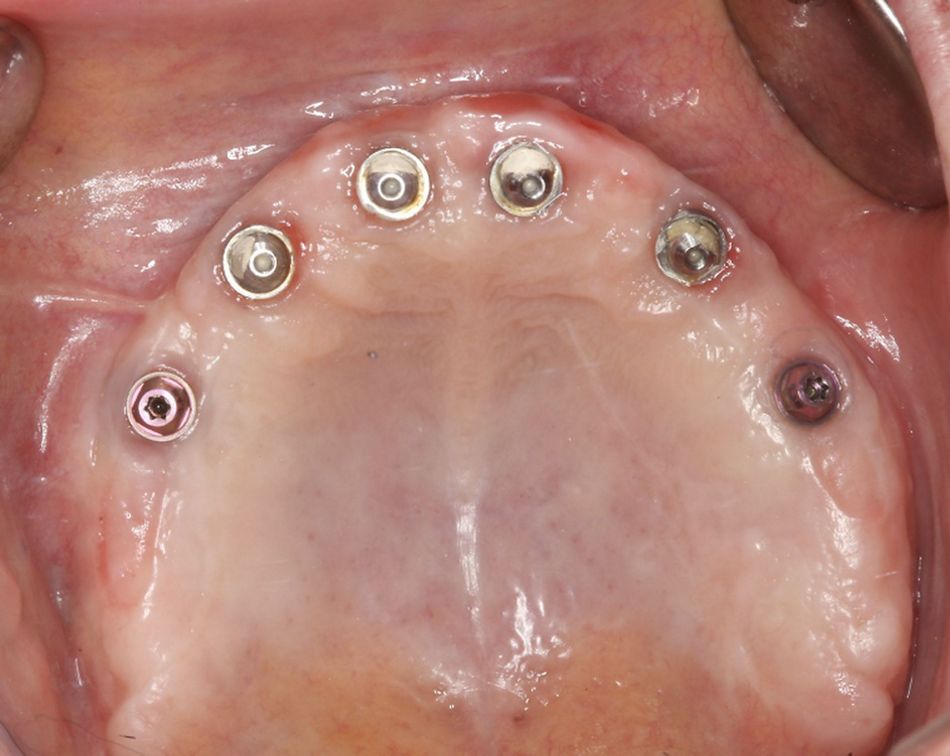 Fig.22.	One year-soft tissue, occlusal  The one-year control shows the results of combining the use the ZAGA Concept for hard and soft tissue management and an implant design (Straumann Zygomatic implant ZAGA flat) with features adapted to the patient anatomy.  Excellent bone and soft tissues stability around Straumann zygomatic abutments have been achieved. 
