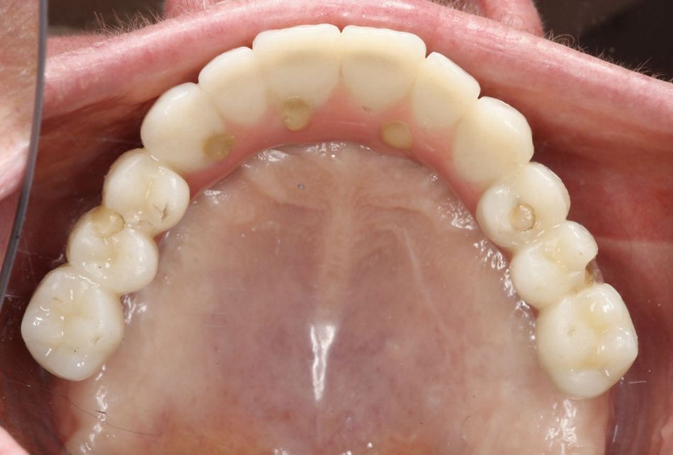 Fig.23.	One year-prostheses, occlusal One-year occlusal view of the prostheses placed by Drs. Peter and Madalina Simon, ZAGA Center Stuttgart, Germany. Note the anatomic, prosthetically driven, position of the implants achieved with straight, non-angulated, abutments.