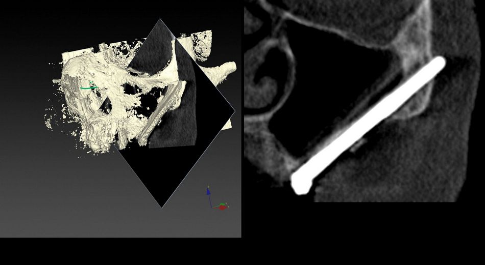 Fig.24.	UL post.23/6/2020 (1yr) CBCT oblique 2D cut and correspondent plane on 3D vision showing implant position and sinus status of the left implant at the one-year control. Totally transparency of the maxillary sinus is maintained.