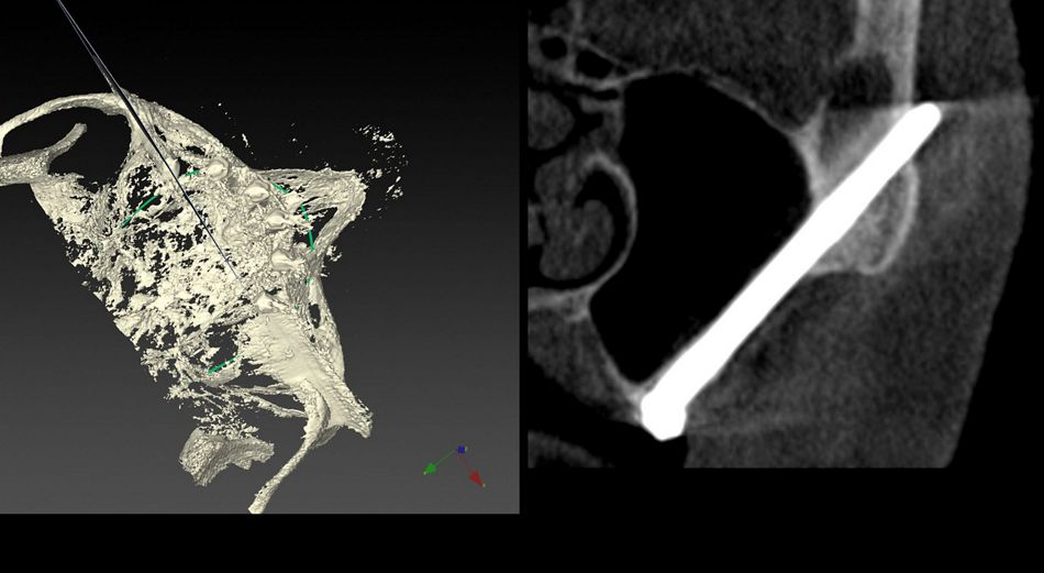 Fig.25.	UR post.23/6/2020 (1yr)  CBCT oblique 2D cut and correspondent plane on 3D vision showing implant position and sinus status of the right implant at the one-year control. Totally transparency of the maxillary sinus is maintained. 