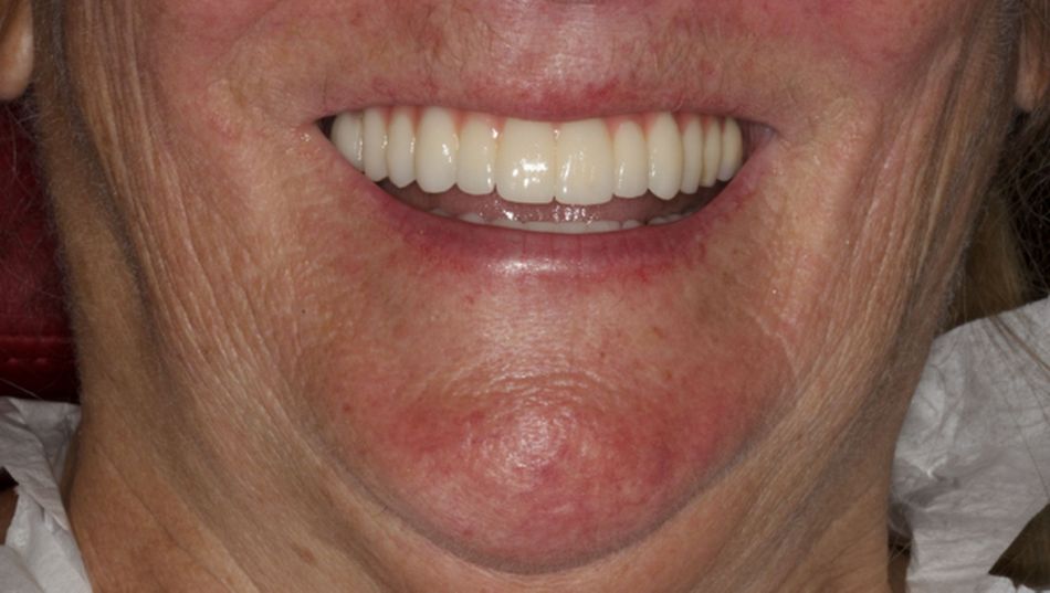 Fig.26.	Smiling. 23/6/2020 (1yr) Patient satisfaction is showed at one-year control 