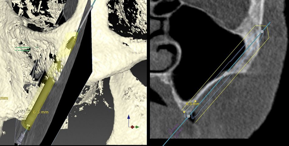 Fig. 3	UL 25 Virtual (extra-sinus planning) The virtual planning of the left side represents a ZAGA type 4 situation. By a lateral displacement of the osteotomy an increased titanium to bone contact is achieved while maintaining sinus lining integrity.