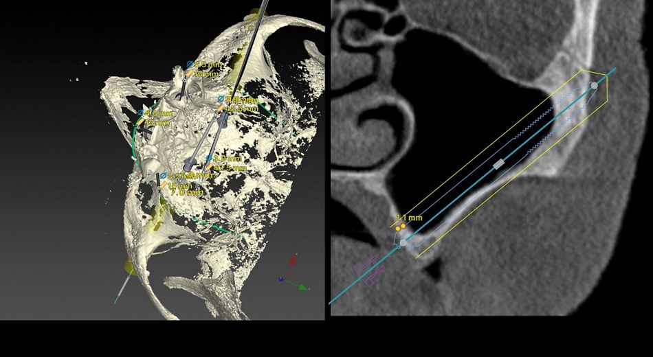 Fig. 4.	UL 25 Virtual (intra-sinus planning) The virtual planning of the same patient and hemimaxilla of the fig. 3, is showing an intra-sinus path. Possibility for late peri-implant bone resorption and oral-antral fistula must be foreseen. Patient related factors like periodontal history or smoking habits must also be considered for decision taking.