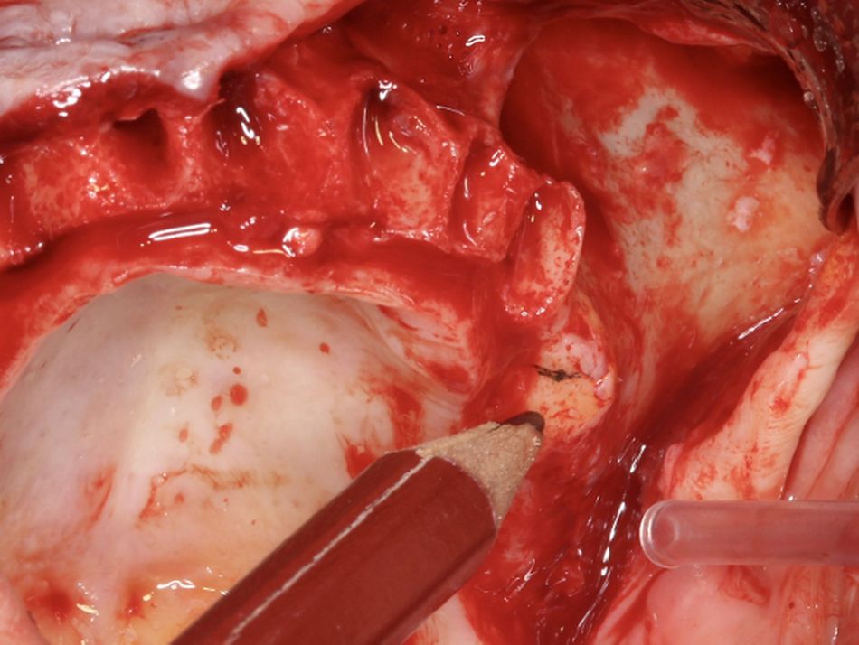 Fig. 5.	Pencil Left Surgeon first act after raising the flap should be to mark the reference points for the alveolar and zygomatic bone entrances.