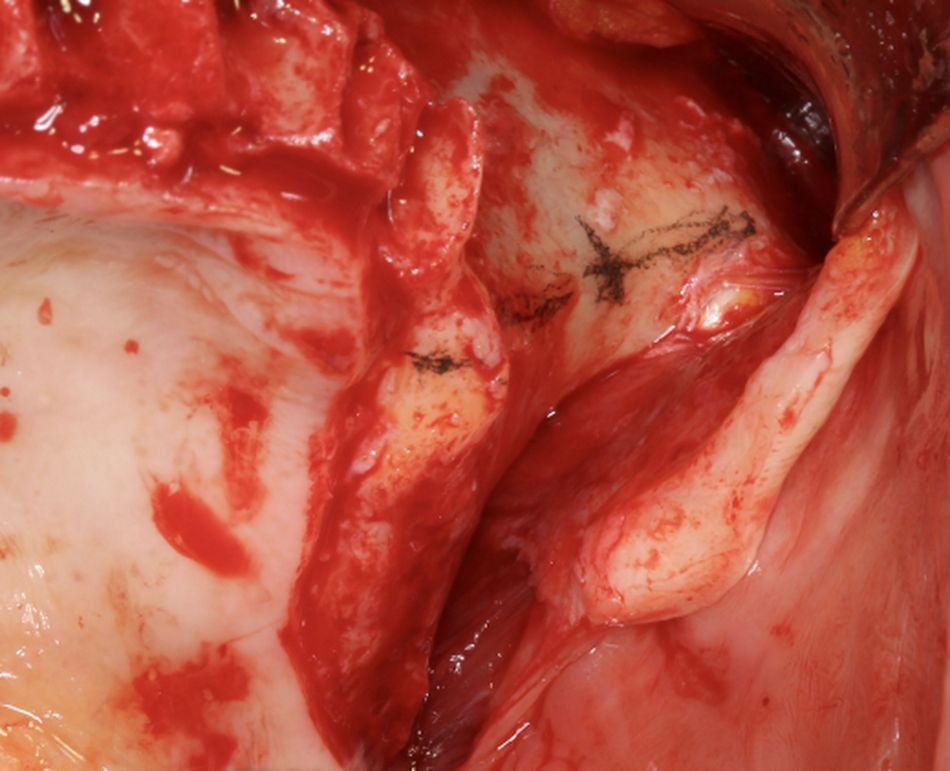 Fig.6.	Pencil Left 2  Clinical picture illustrating how the surgeon is marking the coronal and the zygomatic entrance points on the left second premolar/first molar position according to the virtual planning of Fig. 3.