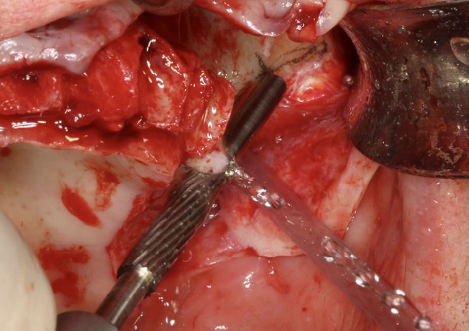 Fig.7.	Channel left initial lateral cutting bur As the alveolar thickness is less than 4 mm a “tunnel” type osteotomy is not recommended. The lateral cutting bur helps to initiate a canal, were the next drill tail will slide. The canal diameter should still be reduced at this stage to precisely embrace and guide the next bur tail. Please note that just the first part of the drill is used in order to prepare a channel with a diameter congruent to the round bur tail.  A slight adaptation of the step 7 allows for the use of a round bur (see steps 8 and 9) to precede the use of the lateral cutting bur. Considering that the hardness of the bone shall guide the decision, the presented sequence is adapted to this particular clinical case.