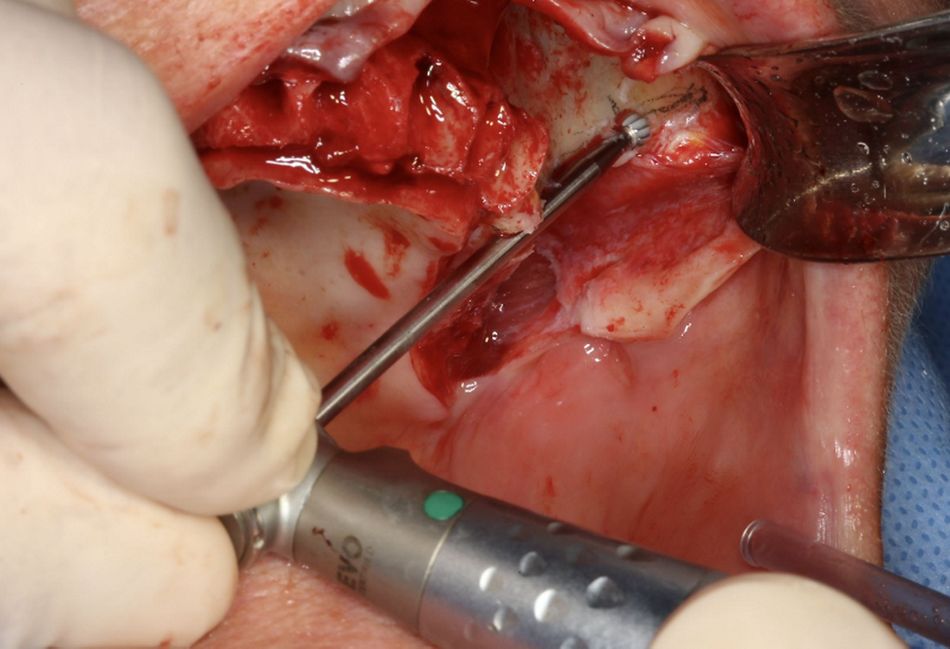 Fig.8.	Channel left, round bur The round bur tail being supported by the alveolar channel, this is the right time to evaluate the direction, the depth and the inclination of the future implant trajectory. Once the channel showed the desired depth, the floor surface shall become even, the round bur tail shall be able to gently slide up and down. The grinding with the round bur becomes more precise by gently touching the bone during the slide down movement.
