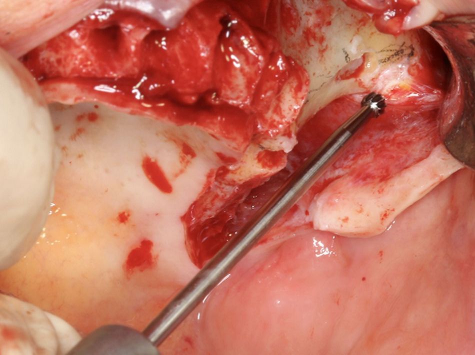 Fig.9.	Channel left round bur2 With extreme precision the round bur has previously completed the channel grinding. The picture shows a notch marked at the zygomatic process of the maxillary bone.   The round bur, sliding up and down, has penetrated on the zygomatic process of the maxillary bone. By a “grinding-back” movement the round bur would be able to eliminate channel floor irregularities. The goal being to prepare a smooth surface supporting the trajectory for the next drill.