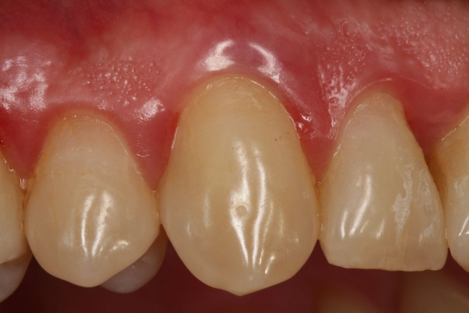 Fig. 1. Baseline clinical findings in tooth 13 after periodontal preparation.